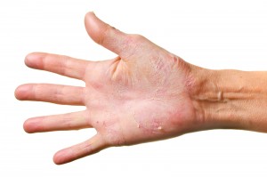 Eczema On A Hand