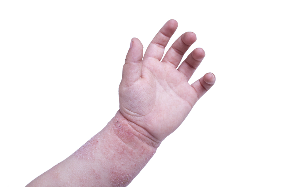 Eczema On The Kid's Hand